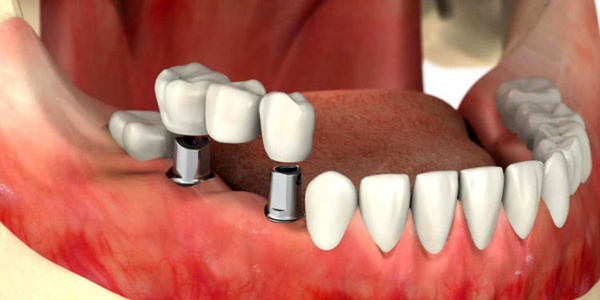 ایمپلنت دندان در کلینک دندانپزشکی دکتر شیخ نژاد